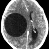Axial CECT reveals a unilocular cyst  in the right cerebral hemisphere with no surrounding edema or enhancement, typical of echinococcus (hydatid disease).