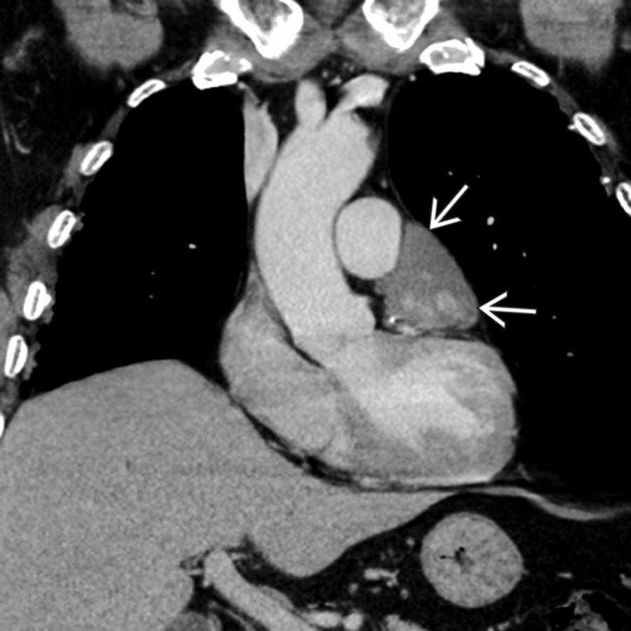 Coronal CECT in a patient with pericardial hemangioma shows heterogeneous contrast enhancement of a pericardial mass adjacent to the left atrial appendage . Fat planes adjacent to the pericardium are preserved, a feature more commonly associated with benign etiology.