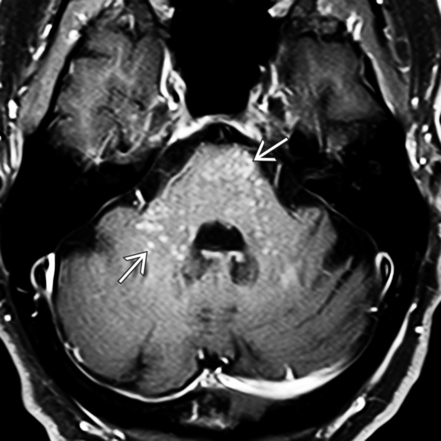Axial T1 C + FS MR in the same patient shows small, punctate foci of enhancement  "peppering" the pons, cerebellar peduncles.