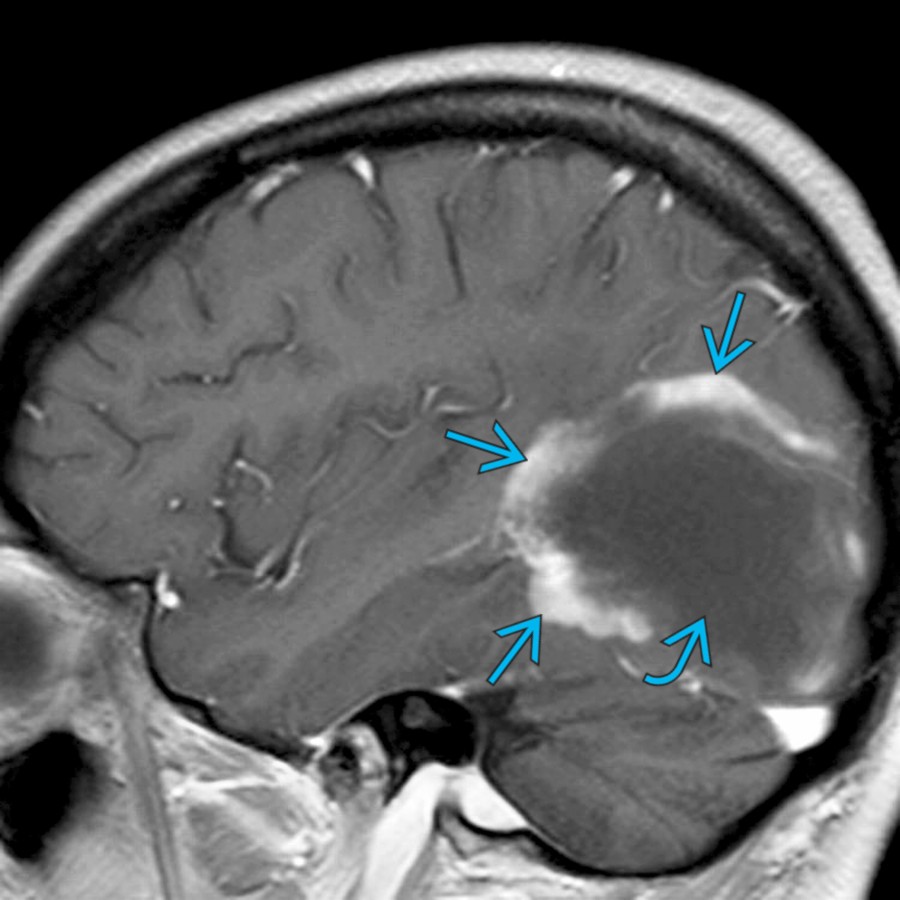 Sagittal T1WI C+ MR shows a large hypointense mass  with a peripheral crescent of incomplete or "open ring" enhancement . This enhancement pattern is classic for a tumefactive demyelinating disease, most commonly MS.