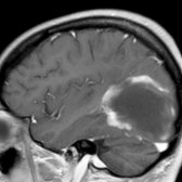 Sagittal T1WI C+ MR shows a large hypointense mass  with a peripheral crescent of incomplete or "open ring" enhancement . This enhancement pattern is classic for a tumefactive demyelinating disease, most commonly MS.