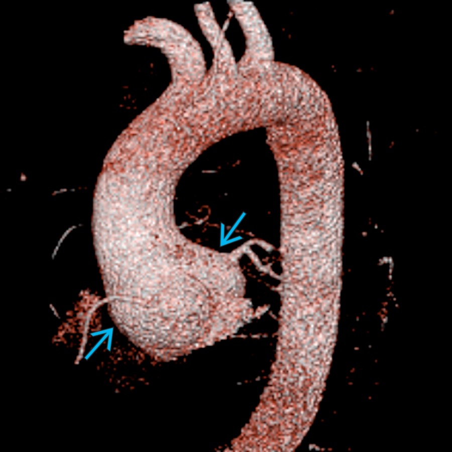 Coronal CECT 3D surface rendering in the same patient shows the so-called tulip bulb configuration    of the ascending thoracic aorta characteristically seen in MFS due to dilatation of the aortic root with normal appearance of the arch and descending thoracic aorta.