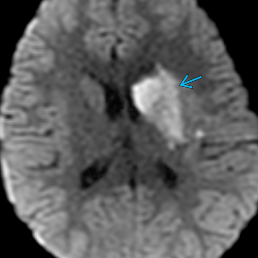 Axial DWI MR in a 6 year old with imbalance and acute infarct of the left basal ganglia  shows diffusion restriction (↓ADC not shown). Acute infarct in a child should prompt further evaluation with MRA or CTA to detect an underlying vessel abnormality.