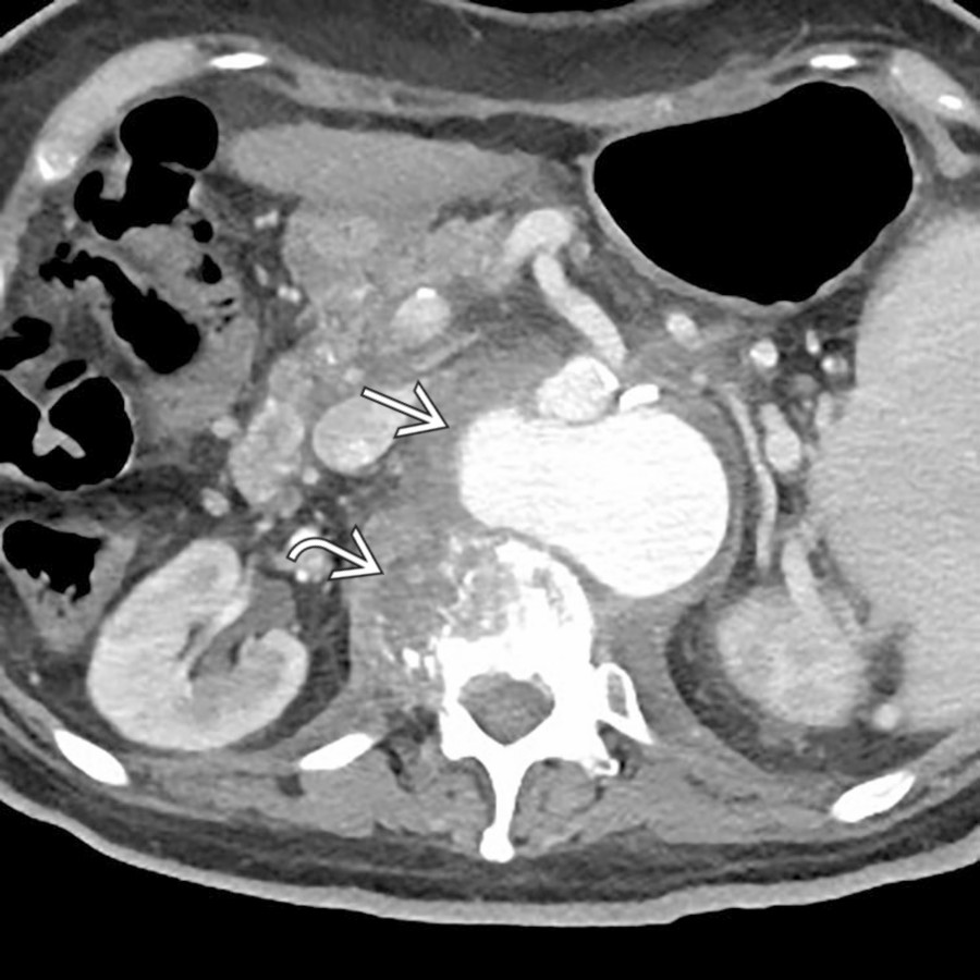 Axial CECT shows lytic destruction of a vertebral body with an abscess  extending into the right psoas muscle. Note the presence of a large mycotic aneurysm  immediately anteriorly arising from the abdominal aorta.