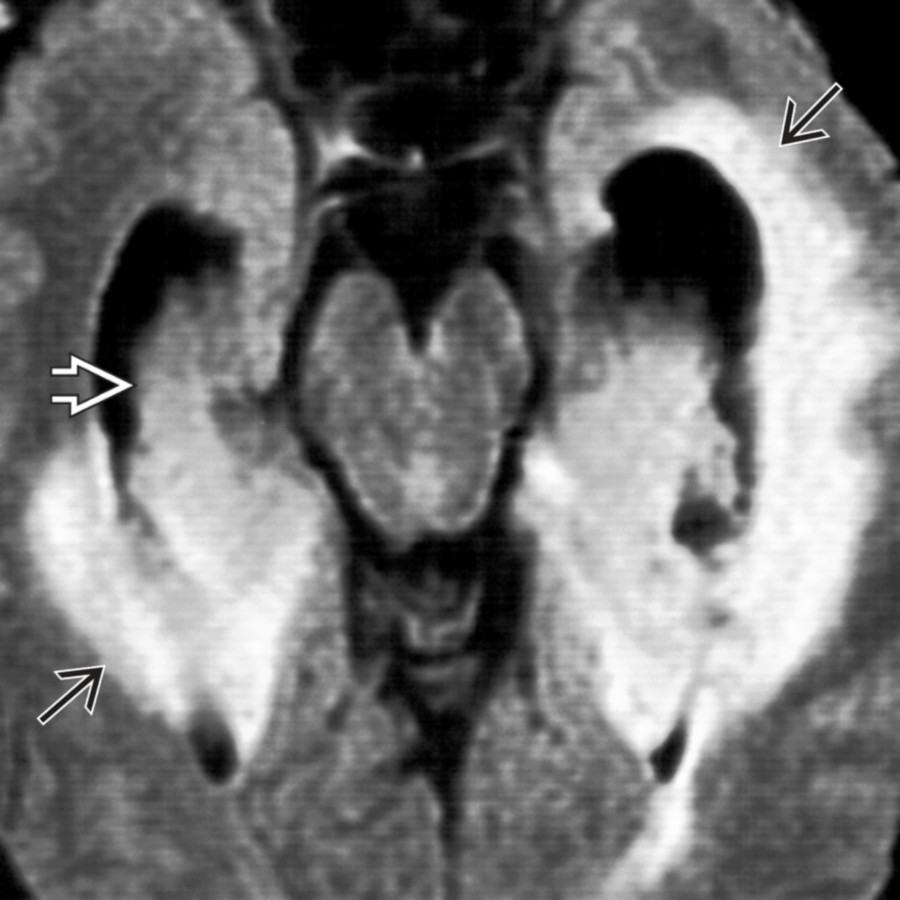 Axial FLAIR MR shows neurosarcoidosis and EVOH secondary to diffuse meningeal disease. Periventricular white matter hyperintensities  are also present, as well as choroid involvement .