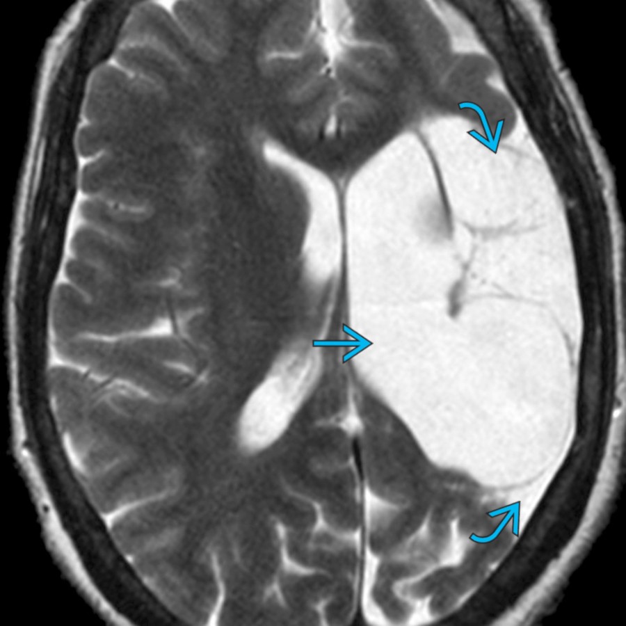 Axial T2 MR demonstrates a large, cystic encephalomalacia in the left frontal and parietal lobes due to chronic infarction  with ex-vacuo dilation of the left lateral ventricle .