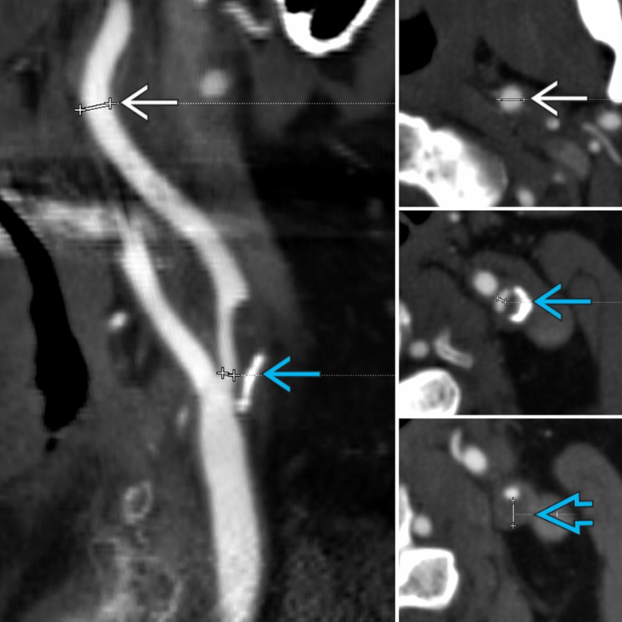 CTA shows a left carotid bifurcation/proximal ICA plaque. NASCET stenosis [(a-b)/a] is calculated by subtracting the maximal stenosis (b ) from the downstream normal-caliber ICA (a ) and normalizing to the downstream normal ICA (a). A single mm stenosis measurement (b) can alternatively be used. Maximum plaque thickness can also be measured on CTA .