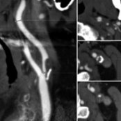 CTA shows a left carotid bifurcation/proximal ICA plaque. NASCET stenosis [(a-b)/a] is calculated by subtracting the maximal stenosis (b ) from the downstream normal-caliber ICA (a ) and normalizing to the downstream normal ICA (a). A single mm stenosis measurement (b) can alternatively be used. Maximum plaque thickness can also be measured on CTA .