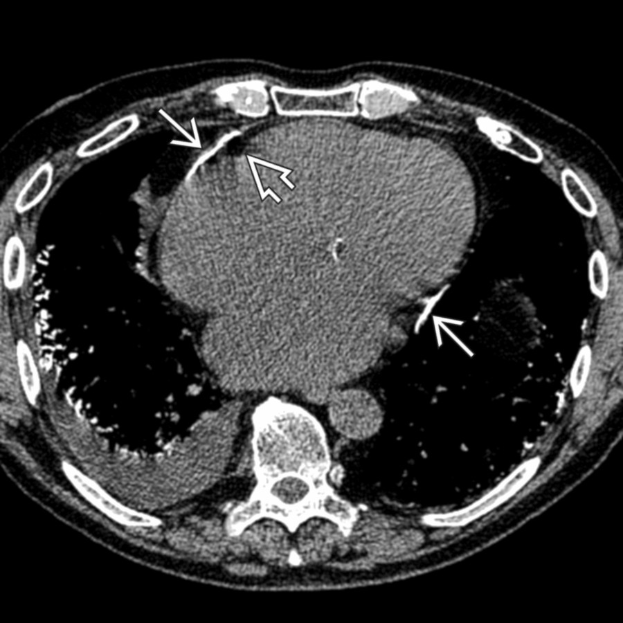 Axial NECT shows pericardial calcification  at the atrioventricular grooves. Note the epicardial fat  to differentiate from coronary calcium.