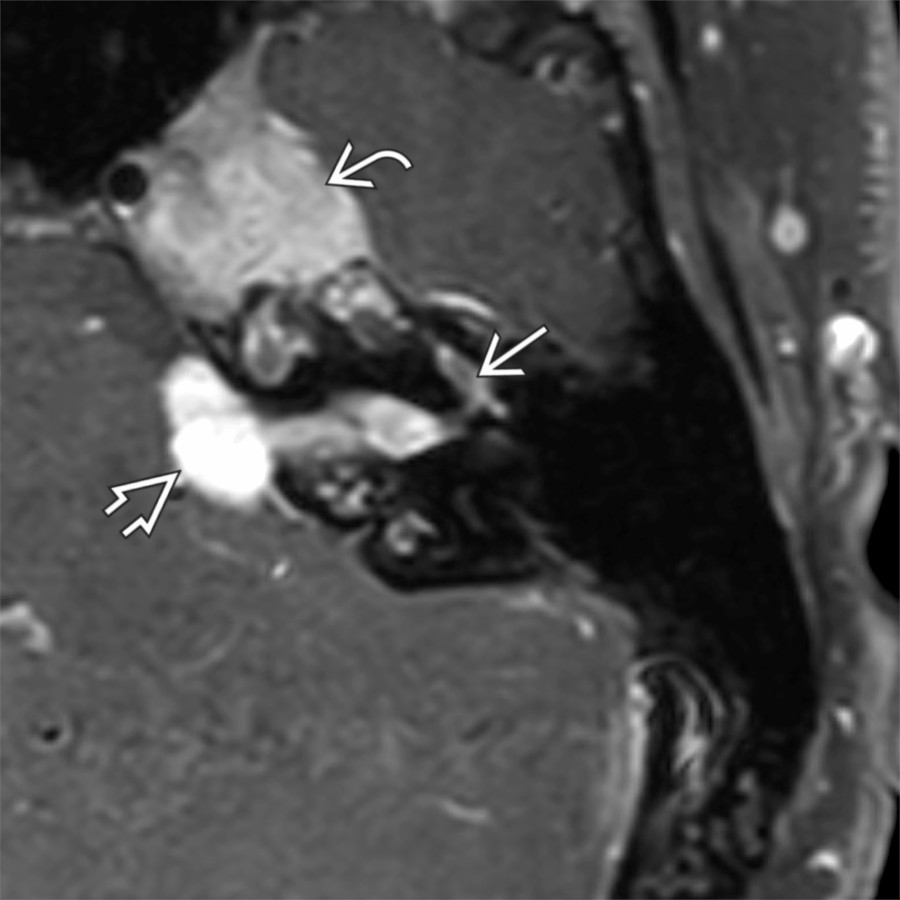 Axial T1 C+ FS MR shows an enhancing schwannoma involving the CPA-IAC   & anterior genu of the facial nerve . This patient with NF2 has a large trigeminal schwannoma  partly seen. A contralateral IAC schwannoma was also present (not shown).