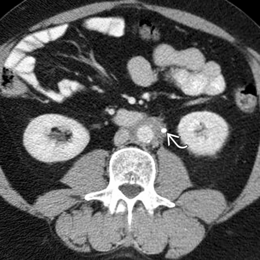 Axial CECT shows mantle of soft tissue encasing aorta, IVC, and ureter (with stent ).