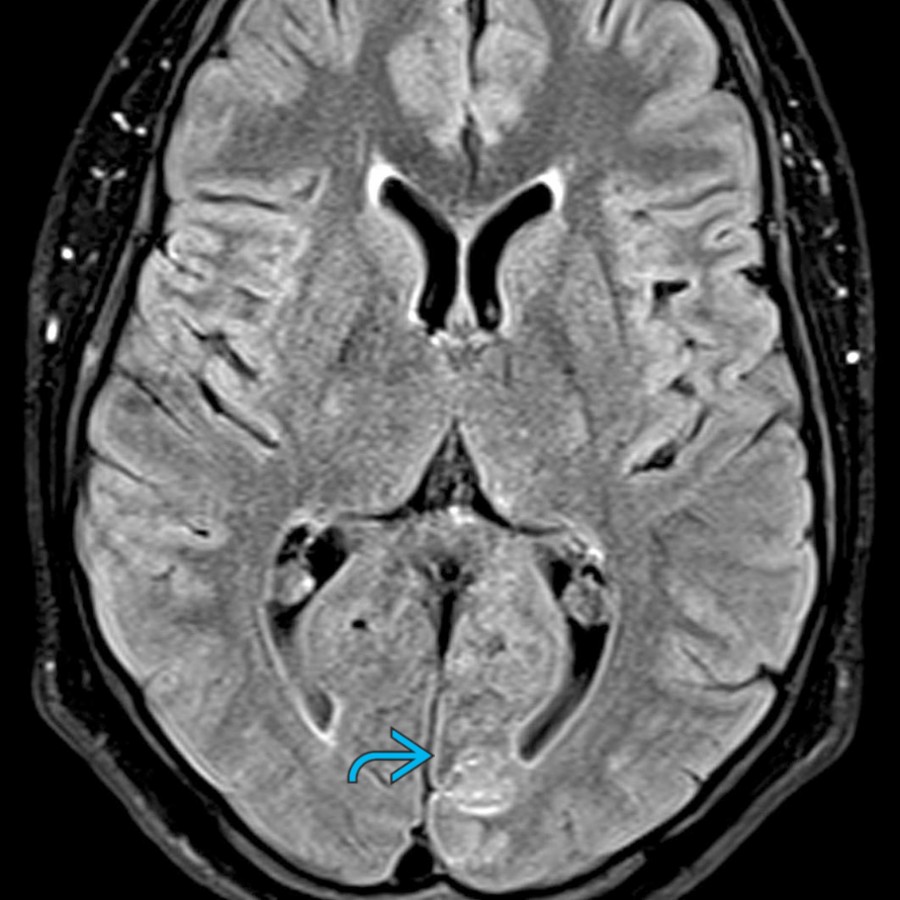 Axial FLAIR MR in the same patient shows the "fogging" effect  with near-normal signal on T2/FLAIR MR with striking enhancement on T1WI C+ MR. This "fogging" effect typically occurs 1-2 weeks following the acute stroke. Initially, the infarct shows hyperintensity, which decreases over time, with isointensity at 1-2 weeks.