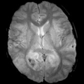 Axial SWI MR in the same patient shows petechial hemorrhages  in regions of FLAIR signal abnormality.