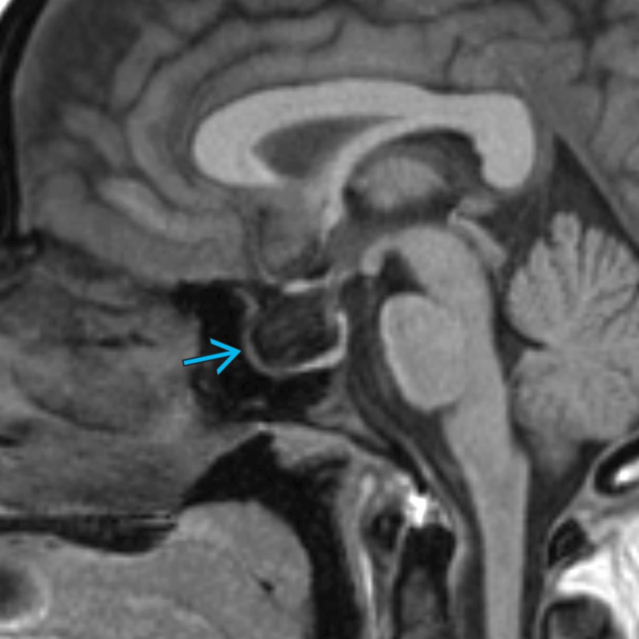 Sagittal T1 MR shows an expanded and empty sella  in this patient with idiopathic intracranial hypertension. There is flattening of the pituitary gland along the sella floor.