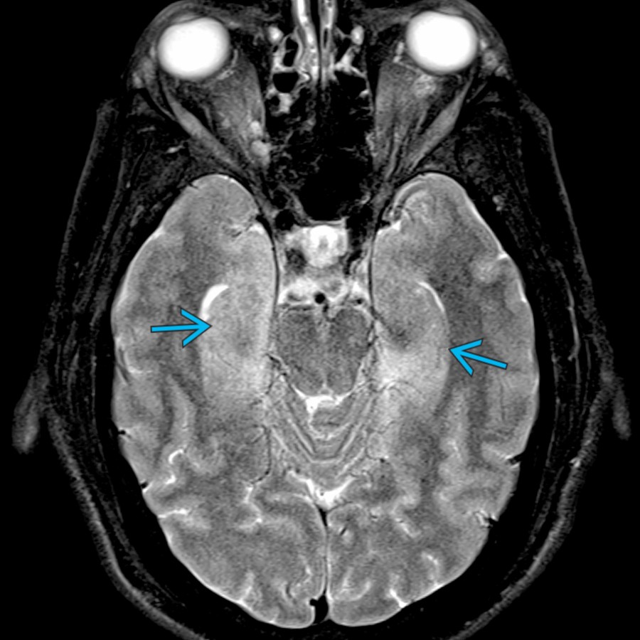 Axial T2 FS MR shows bilateral hippocampal hyperintensity and edema . Herpes encephalitis typically involves the medial temporal lobes asymmetrically and the insular cortex. The basal ganglia is usually spared, and there is deceased diffusion of the cortex early in the disease.