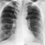 PA radiograph of the chest demonstrates the classic figure 3 morphology in a patient with aortic coarctation. Note the area of stenosis , dilated subclavian artery , and poststenotic dilatation .
