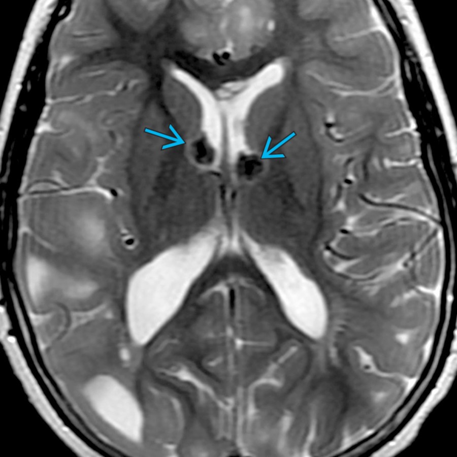 Axial T2 MR shows calcified subependymal nodules in the foramen of Monro region  in this child with seizures, mimicking BG Ca⁺⁺. These nodules occur in 98% of patients with tuberous sclerosis.