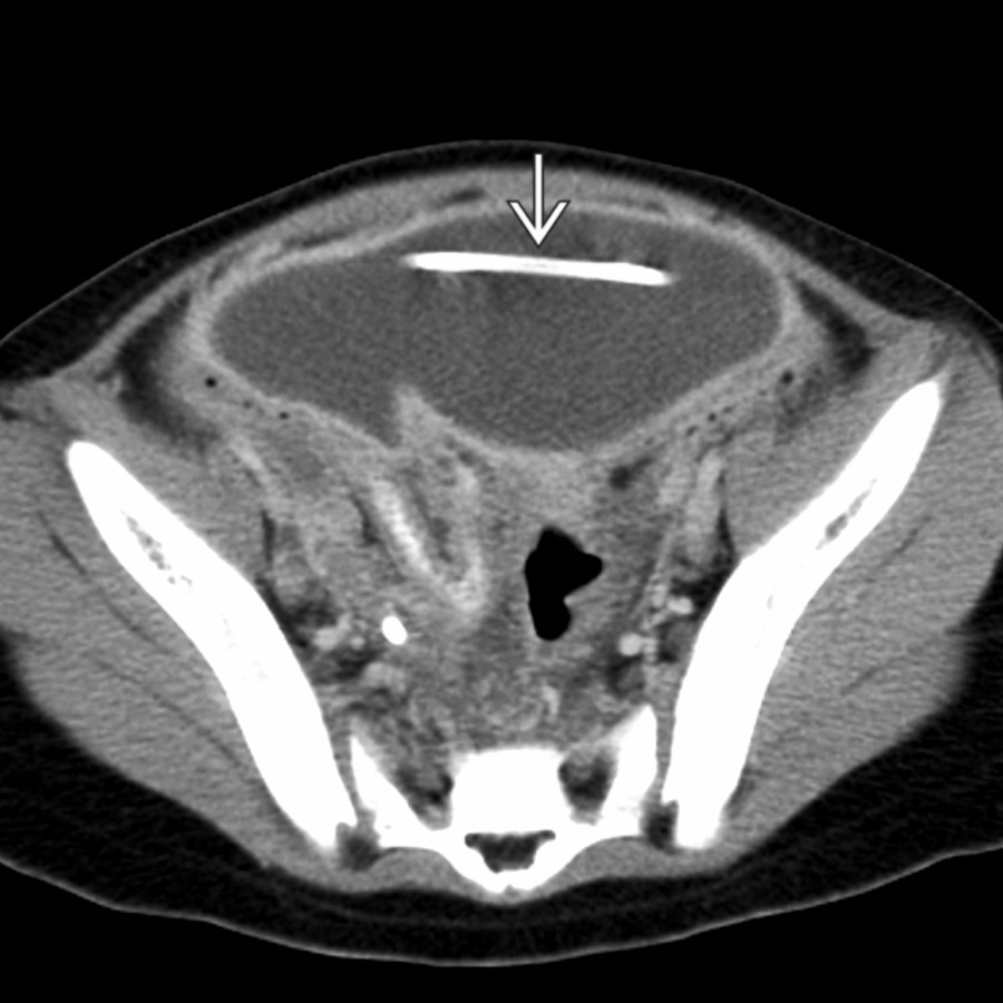 Axial CECT of the pelvis in a shunted patient with HCP presenting with acute shunt failure, fever, and abdominal pain shows the peritoneal VP shunt catheter  residing within a rim-enhancing pelvic fluid collection that represents a pelvic abscess secondary to perforated appendicitis.