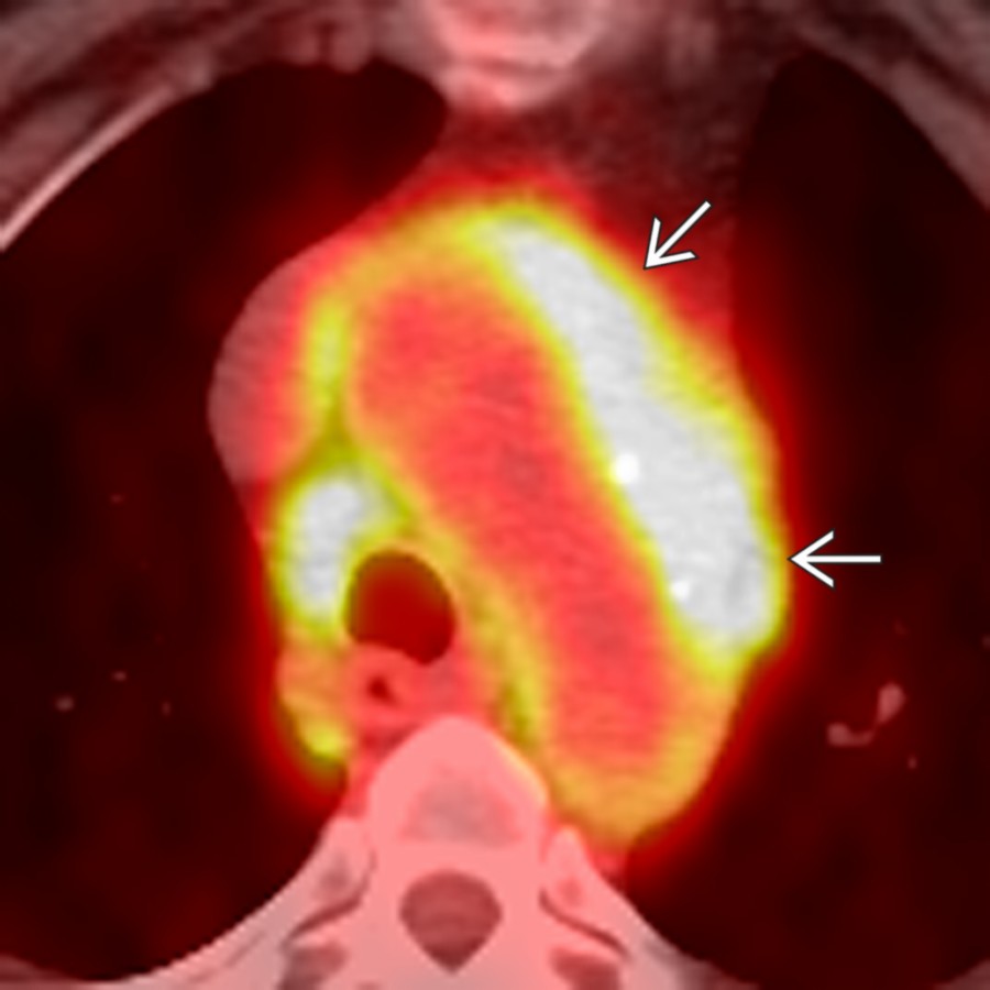 Axial fused PET/CT in a patient with active TA demonstrates intense FDG uptake within the mediastinum adjacent to the aortic arch  in a region of soft tissue attenuation that was present on the localization CT.