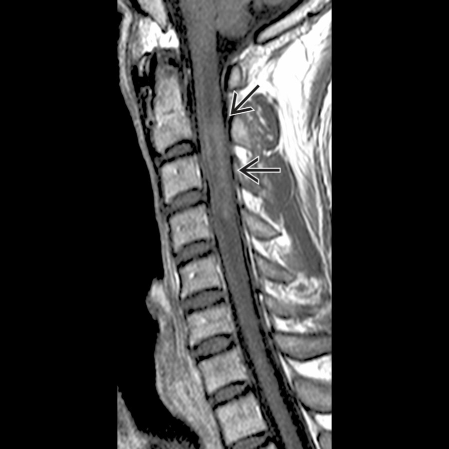 Sagittal T1 C+ MR shows patchy enhancement  and mild enlargement of cervical cord due to multiple sclerosis (Devic subtype).