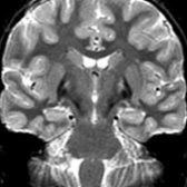 Coronal T2WI MR captures all the main imaging features of PKAN: Eye of the tiger sign in the globus pallidi  with symmetric hypointensity in the surrounding globus pallidi and substantia nigra .