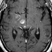 Axial T1 C+ MR in the same patient shows patchy enhancement of the midbrain lesions  and the medial temporal lobe . This patient was diagnosed with LE with new brainstem symptoms. Multiple paraneoplastic syndromes may occur in the same patient.