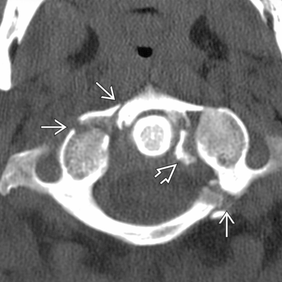 Axial bone CT shows severe comminuted fractures involving both the posterior and anterior arches of C1 . There is also an avulsion off of the medial aspect of the left C1 lateral mass at the insertion of the transverse ligament . The atlantodental interval is normal.