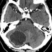 Axial CECT shows a large, rim-enhancing, cystic mass in the right cerebellar hemisphere with mass effect on the 4th ventricle and only minimal associated edema. At surgery, a metastasis related to HPV-positive oropharyngeal squamous cell carcinoma was found.