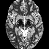 Axial T2* GRE MR in a patient with classic PKAN shows blooming of hypointense signal in the inferior globus pallidus and substantia nigra . Abnormal iron accumulation within the substantia nigra is more conspicuous on imaging as the disease progresses.