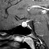 Sagittal T1 C+ MR in a 19-year-old female patient shows a very rounded appearing pituitary gland . Although it appears somewhat enlarged, it measures only 8 mm in height. The bony sella are unusually shallow, giving the appearance of pituitary enlargement.