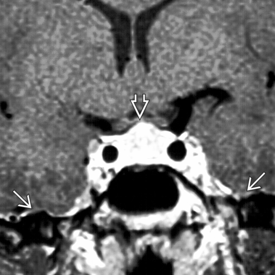 Coronal T1WI C+ MR in the same patient shows an enlarged pituitary gland  with mild dural thickening .