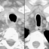 Composite image with axial NECT at the thoracic inlet (left) and axial NECT at a lower level (right) of a patient with COPD shows the normal shape of the extrathoracic trachea  and the saber-sheath configuration  of the intrathoracic trachea.