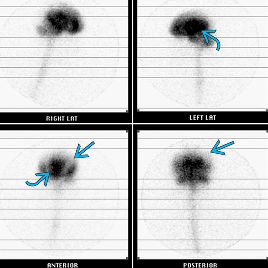Twenty-four hour multiplanar In-111 DTPA cisternography in a patient with NPH shows radiotracer in the lateral ventricles  with lack of activity over the convexity . Normally, there should be radiotracer movement over the convexities at 24 hours. (Courtesy C. Singh, MD and A. Ali, MD.)