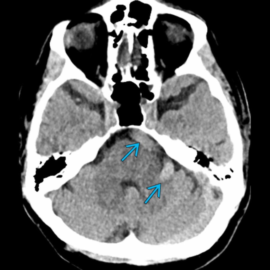 Axial CT shows fusiform dilatation and tortuosity of the basilar artery  in an octogenarian related to dolichoectasia. Fusiform dolichoectasia is a common finding in the vertebrobasilar arteries in older patients.