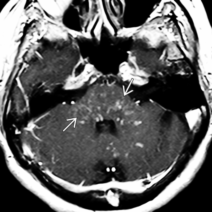 Axial T1 C+ MR in the same patient shows multiple punctate and curvilinear enhancing foci "peppering" the pons . Additional lesions are present in both cerebellar peduncles, vermis, and the left cerebellar hemisphere.