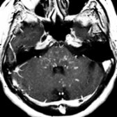 Axial T1 C+ MR in the same patient shows multiple punctate and curvilinear enhancing foci "peppering" the pons . Additional lesions are present in both cerebellar peduncles, vermis, and the left cerebellar hemisphere.