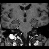 Coronal angled T1 C+ MPRAGE MR reformat in a patient with Miller Fisher syndrome (MFS) shows mild thickening and enhancement of right facial (CNVII)  and bilateral trigeminal (CNV)  nerves.