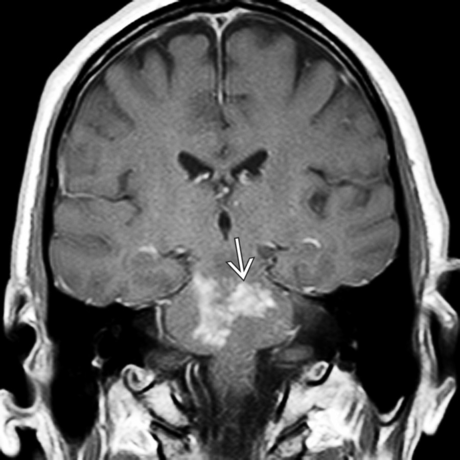 Coronal T1 C+ MR in the same patient shows large, confluent, patchy enhancing lesions  in the pons. Differential diagnosis included lymphoma, lymphomatoid granulomatosis, vasculitis, and CLIPPERS. The patient improved on steroids.