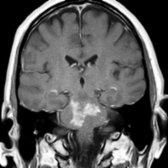 Coronal T1 C+ MR in the same patient shows large, confluent, patchy enhancing lesions  in the pons. Differential diagnosis included lymphoma, lymphomatoid granulomatosis, vasculitis, and CLIPPERS. The patient improved on steroids.