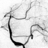 Anteroposterior oblique view of the left vertebral angiogram shows focal elongations and widening of the basilar artery  in a 6-year-old child with Ehlers-Danlos type 4.