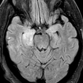 Axial FLAIR MR shows abnormal hyperintensity in the medial temporal lobes bilaterally, characteristic of limbic encephalitis, the most common paraneoplastic syndrome. Bilateral involvement is typical of limbic encephalitis.
