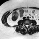 Axial T2 HASTE MR in an older patient with muscle atrophy shows fat in between the individual muscles of the anterior and posterior abdominal wall.