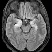 Axial FLAIR MR shows abnormal hyperintensity in the medial temporal lobes bilaterally, characteristic of limbic encephalitis, the most common paraneoplastic syndrome. Bilateral involvement is typical of limbic encephalitis.