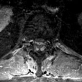 Axial T1WI C+ MR shows thickening and enhancement of ventral and dorsal cauda equina nerve roots .