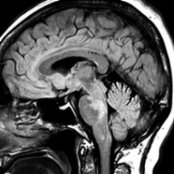Sagittal FLAIR MR in a 56-year-old woman with weight loss and a 3-week history of diplopia and disequilibrium shows confluent and punctate hyperintensities in the pons  and medulla .