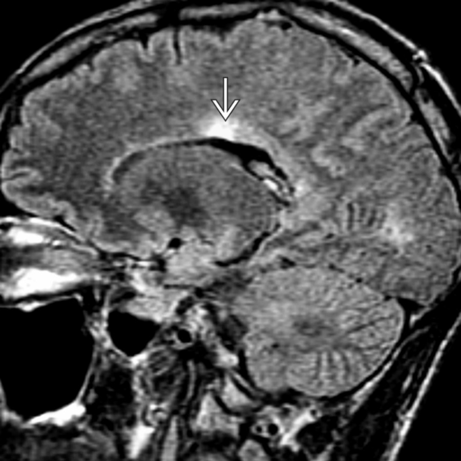 Sagittal FLAIR MR of the brain in a CIDP patient shows a typical paraventricular demyelinating lesion  similar to those seen in multiple sclerosis patients.