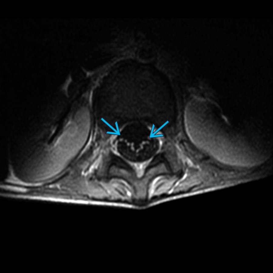 Axial T1 C+ MR of the lumbar spine in a patient with Guillain-Barré syndrome (GBS) shows the characteristic ventral cauda equina (CE) nerve root enhancement  and slight thickening.