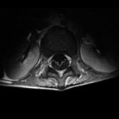 Axial T1 C+ MR of the lumbar spine in a patient with Guillain-Barré syndrome (GBS) shows the characteristic ventral cauda equina (CE) nerve root enhancement  and slight thickening.