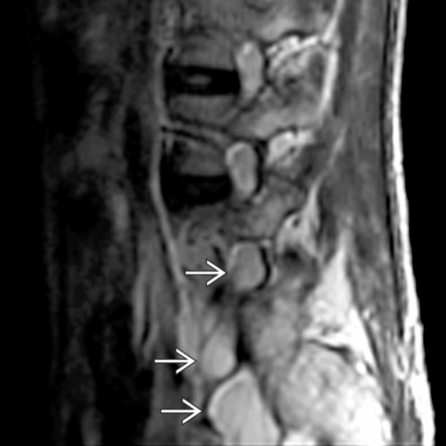 Sagittal T2WI MR depicts enlarged lumbar nerve roots extending into extraforaminal ventral primary rami .
