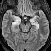 Axial FLAIR MR shows abnormal hyperintensity in the bilateral medial temporal lobes , characteristic of limbic encephalitis (LE), the most common paraneoplastic syndrome. Bilateral involvement is typical of limbic encephalitis.